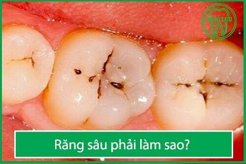 Nhổ răng có ảnh hưởng tới sức khỏe không ? 1
