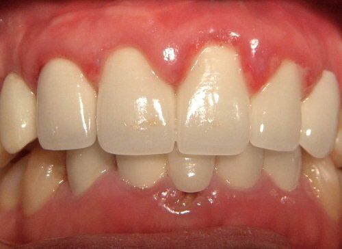 Những biến chứng bọc răng sứ Cercon HT cần lường trước?