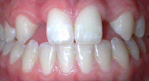 Giải pháp điều trị thưa răng hiệu quả