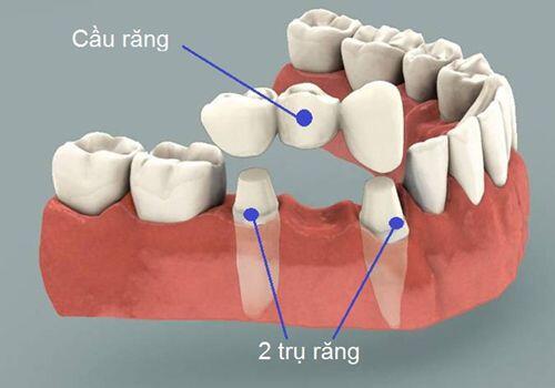 Những hạn chế của phương pháp cầu răng