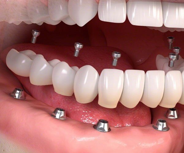 Những phương pháp trồng răng sứ thẩm mỹ hiện nay-1