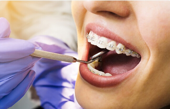 Dịch vụ niềng răng thẩm mỹ tại trung tâm nha khoa 1