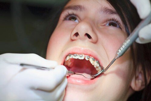 Trẻ em niềng răng không cần nhổ răng