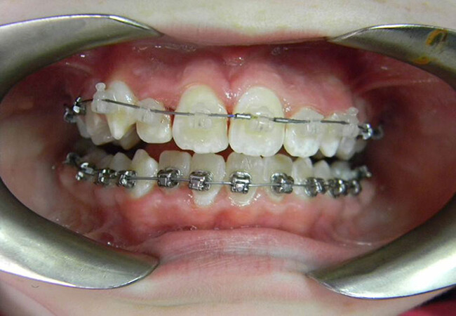 Niềng răng hô hàm dưới