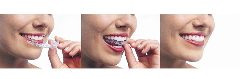 Phương pháp niềng răng không mắc cài Invisalign-1