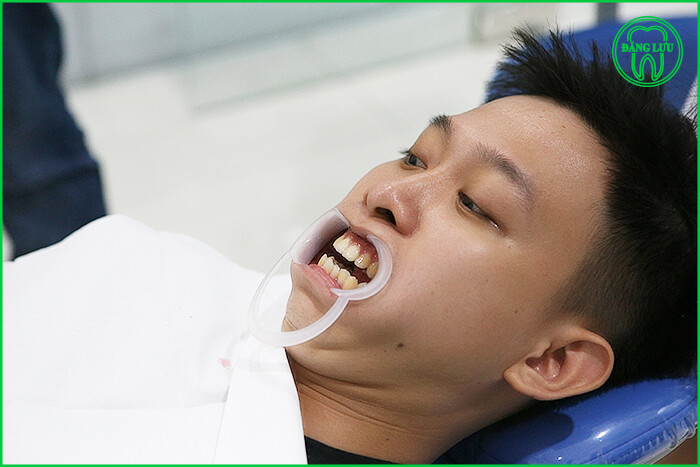 Niềng răng mặt lưỡi tại TP.HCM-1