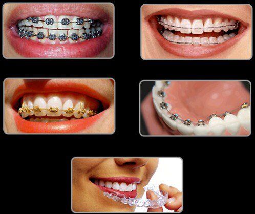 Niềng răng điều trị hô trong bao lâu?