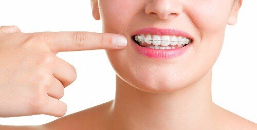 Sự phong phú của các phương pháp niềng răng