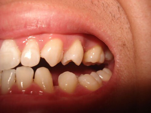 Phân loại các dạng thưa răng thường gặp
