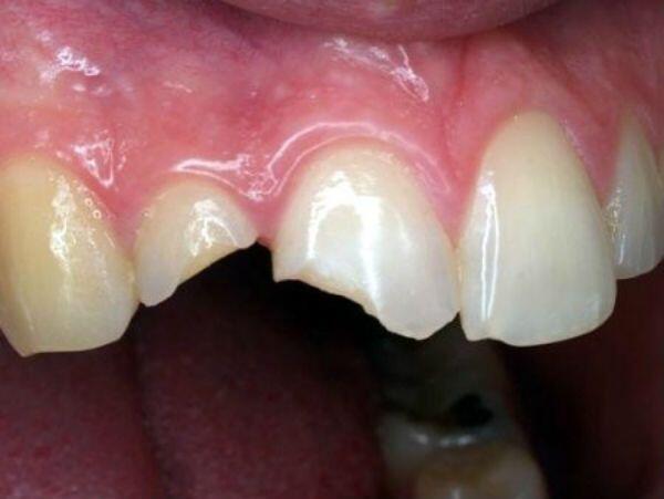 Chân răng còn tốt thì nên phục hình thế nào?-2