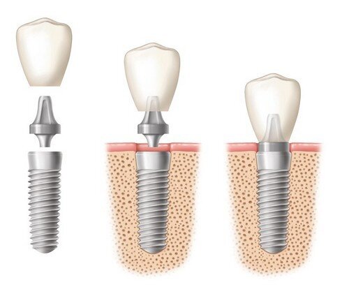 Cấy ghép implant có dị ứng với răng miệng không ?
