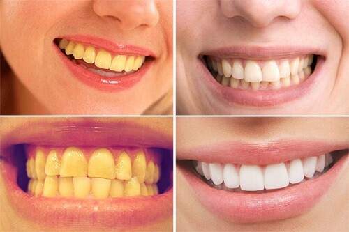 Phương pháp làm trắng hàm răng ố vàng 1