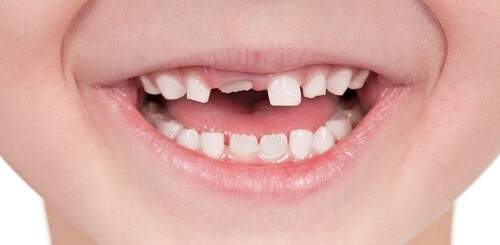 Quá trình thay răng sữa diễn ra thế nào?-3