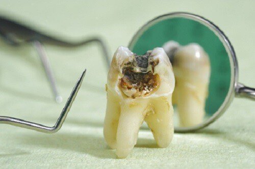 Quan niệm và sự thật về bệnh sâu răng