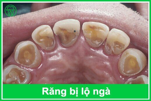 Điều trị tình trạng răng bị lộ ngà-1