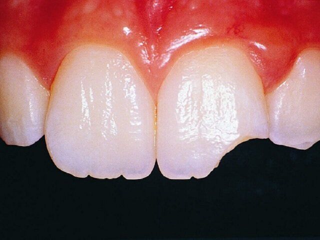 Cách bảo vệ tủy răng khi răng bị gãy, mẻ