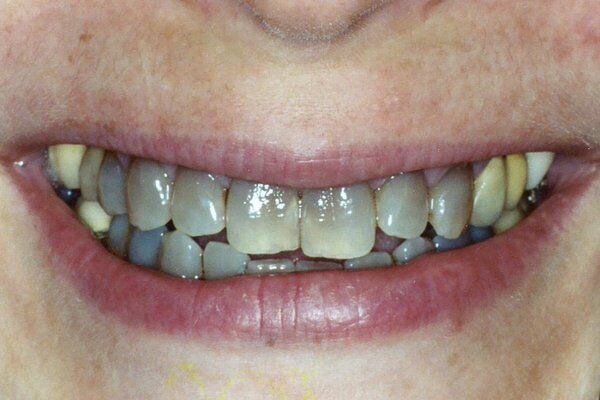 Nguyên nhân gây vàng răng cơ bản-1