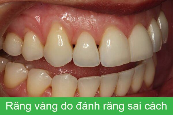 Những sai lầm khi đánh răng làm răng ố vàng-1
