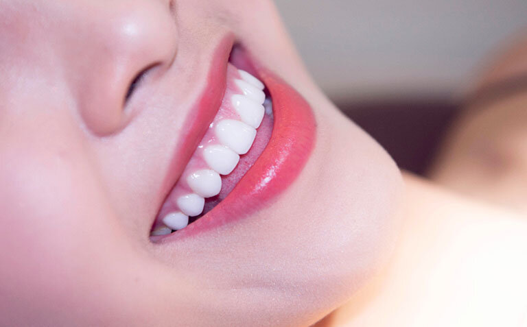 Những thắc mắc liên quan đến việc bọc răng sứ