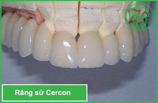 Nên bọc răng sứ Cercon ở đâu?