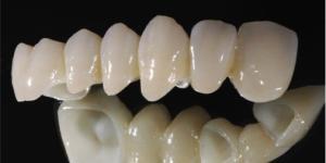 Răng sứ Cercon sử dụng được bao lâu?