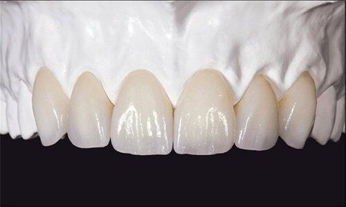 Răng sứ không kim loại Zirconia là gì?