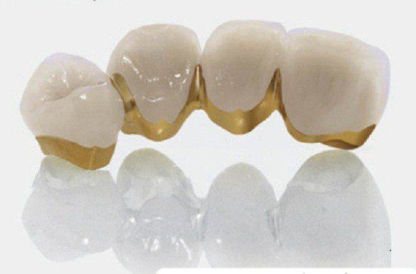 Răng sứ Titan bảo hành bao nhiêu năm?