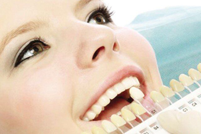 Răng sứ Veneer bảo hành bao nhiêu năm?