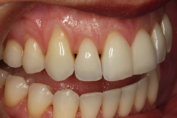 Nguyên nhân gây vàng răng cơ bản-2