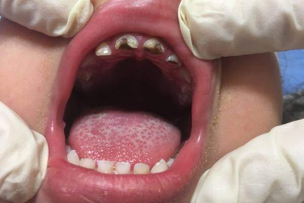 Diễn biến nghiêm trọng của bệnh sâu răng-1