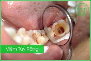 Hình thể lâm sàng và triệu chứng viêm tủy răng-1