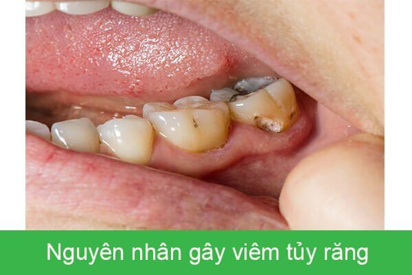 Nguyên nhân gây viêm tủy răng-1