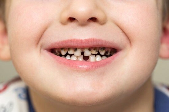 Sâu răng ở trẻ em và cách phòng ngừa 1