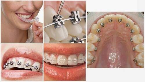 Tác dụng của niềng răng chỉnh nha-1