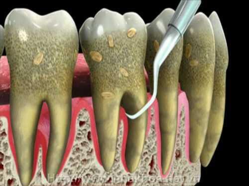 Tác hại của cao răng bạn nhất định phải biết-1