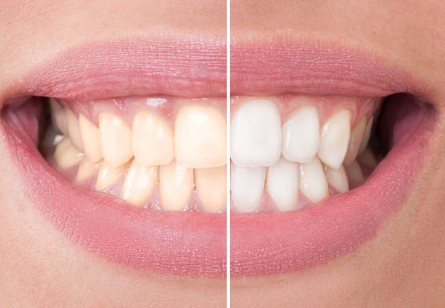 Tẩy trắng răng nhiều lần có sao không? 1