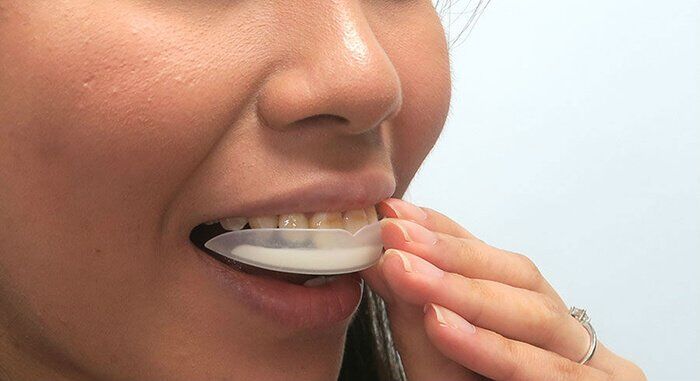 Thận trọng với hàm lượng thuốc tẩy trắng răng tại nhà-1