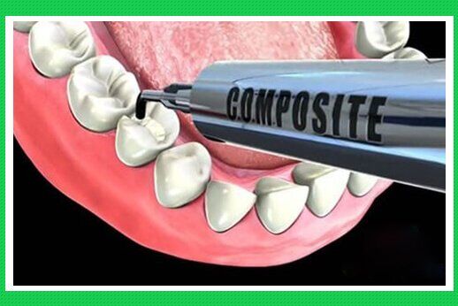 Thời gian sử dụng của răng trám Composite được bao lâu?-1