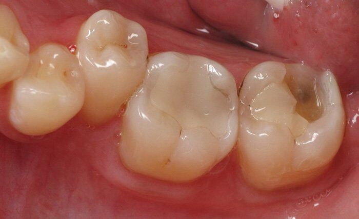 Trám răng Composite có những ưu điểm gì ?