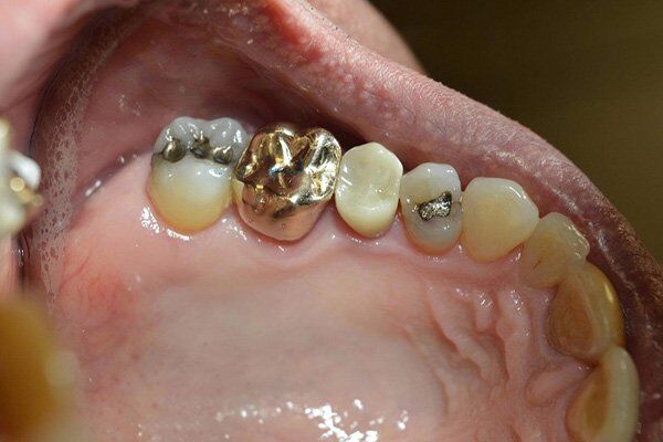 Chăm sóc răng miệng để phòng ngừa sâu răng
