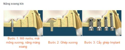 Trồng răng implant kết hợp nâng xoang hàm và ghép xương-1