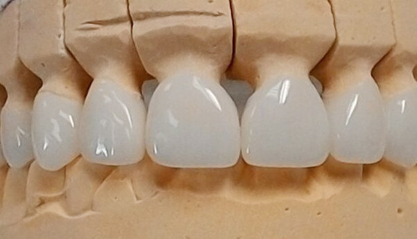 Ưu điểm của răng sứ Zirconia?