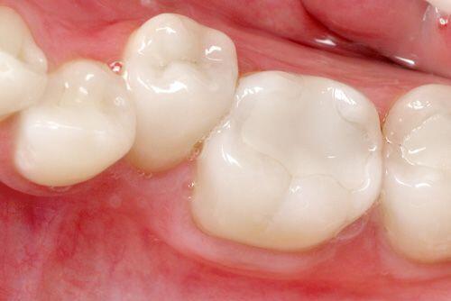 Trám răng cho tình trạng thiếu sản men răng