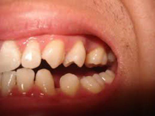 Điều trị răng thưa 1 lần đạt hiệu quả lâu dài
