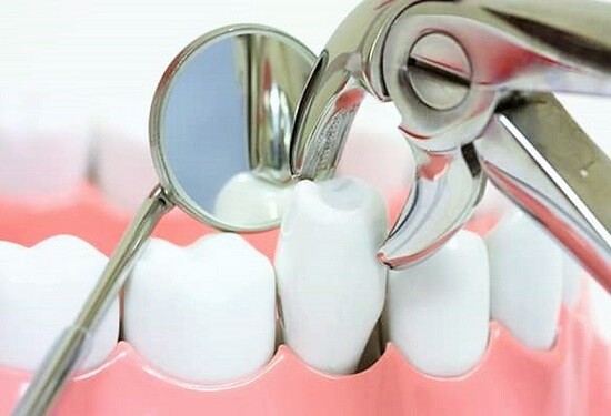 Vì sao nên nhổ răng? 1