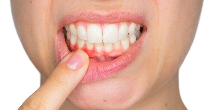 Thận trọng với hàm lượng thuốc tẩy trắng răng tại nhà-2
