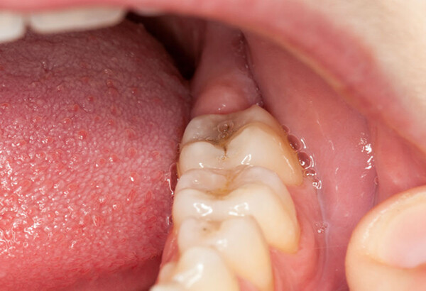 Có nên nhổ răng khôn để điều trị viêm lợi trùm?-1