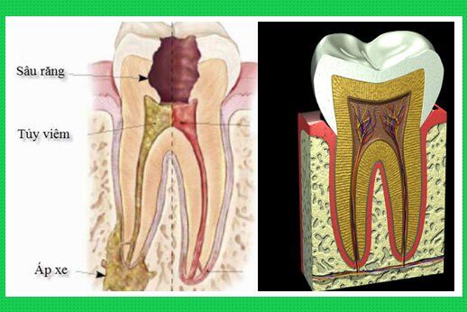 Nguyên nhân và triệu chứng của bệnh viêm tủy răng-1