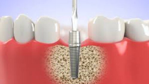 Những đối tượng không nên làm răng implant-1
