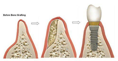 Trồng răng khi bị tiêu xương có phức tạp không ?